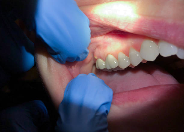 Best Broken or Chipped Tooth Repair in Irving, TX